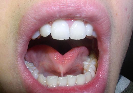 anchiloglossia