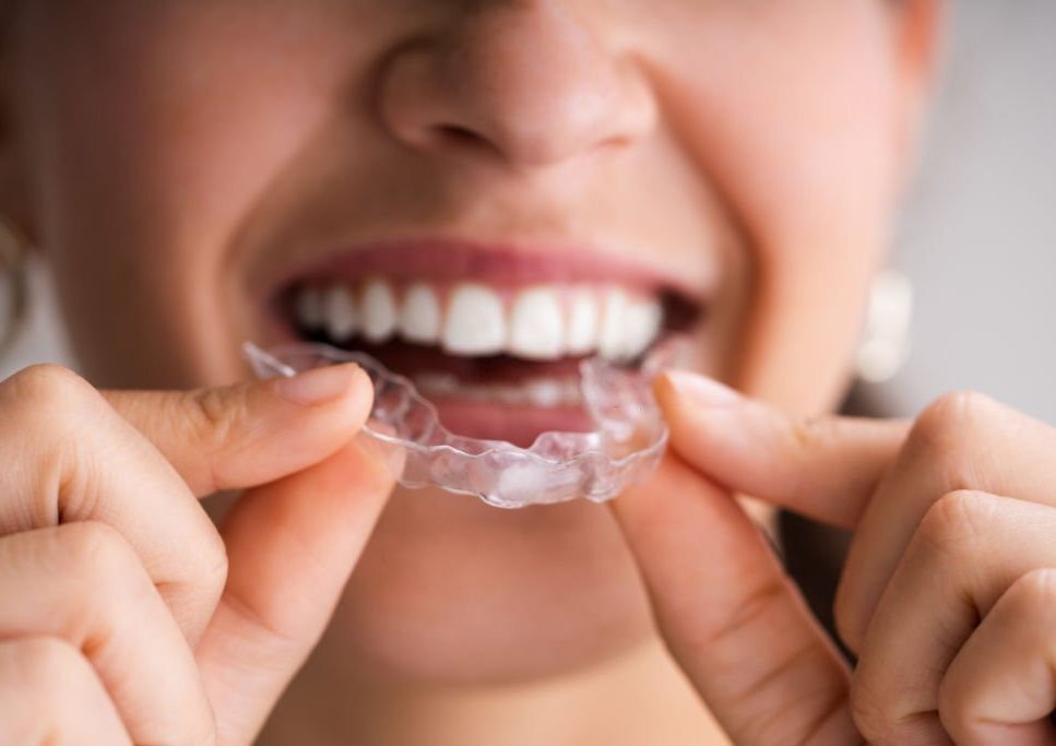 Clear Aligner Dental Night Guard For Teeth