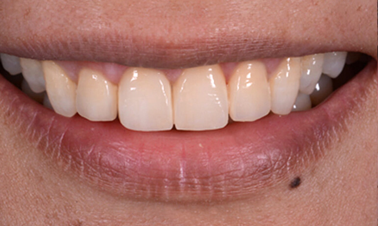 con due sedute denti funzionalmente ed esteticamente perfetti_1