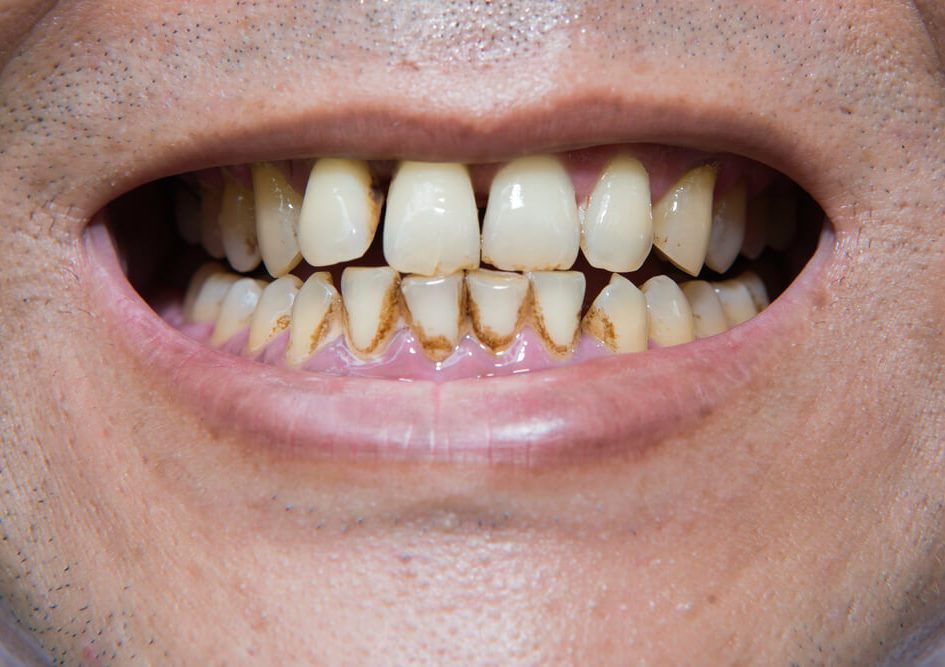denti dei fumatori