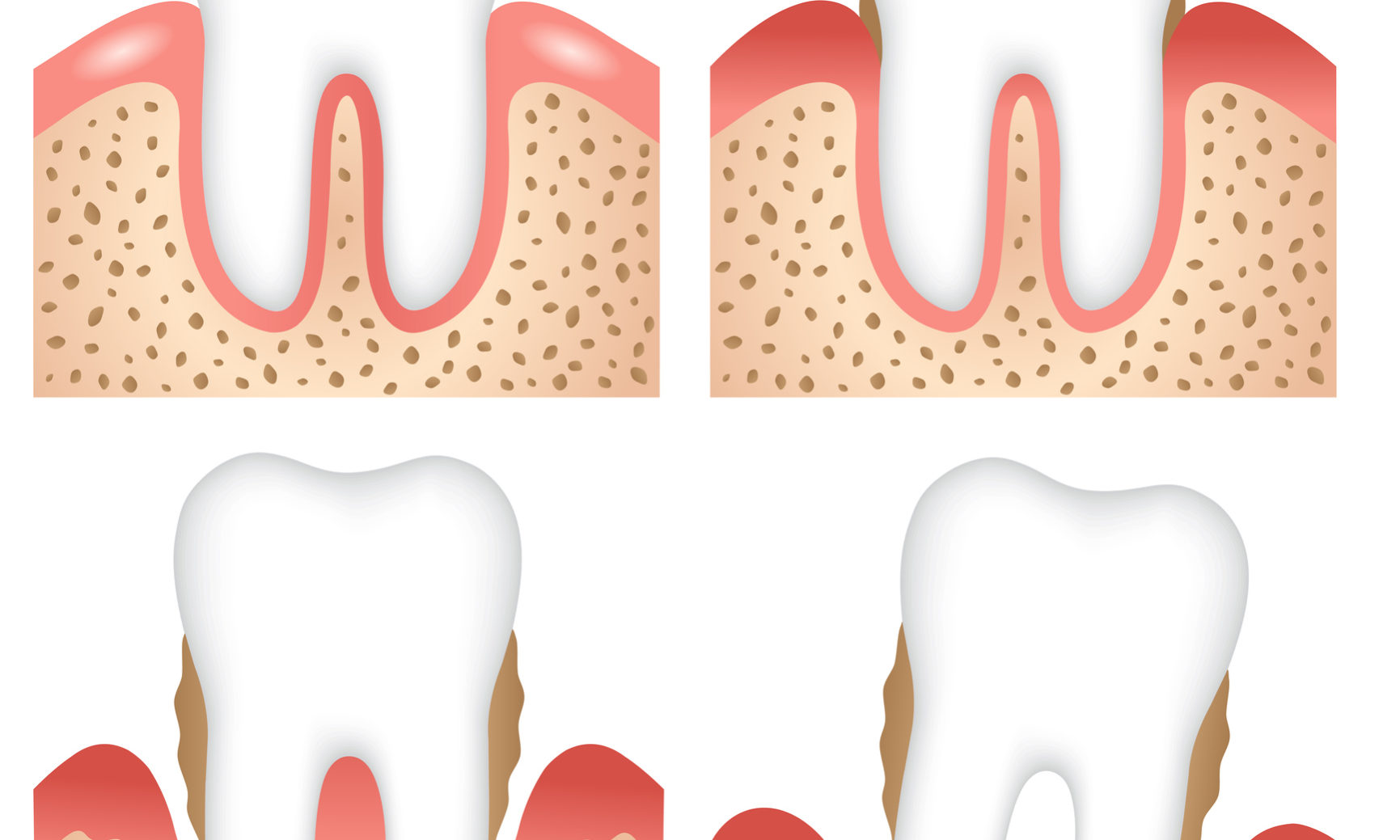emergenza malattia paradontale