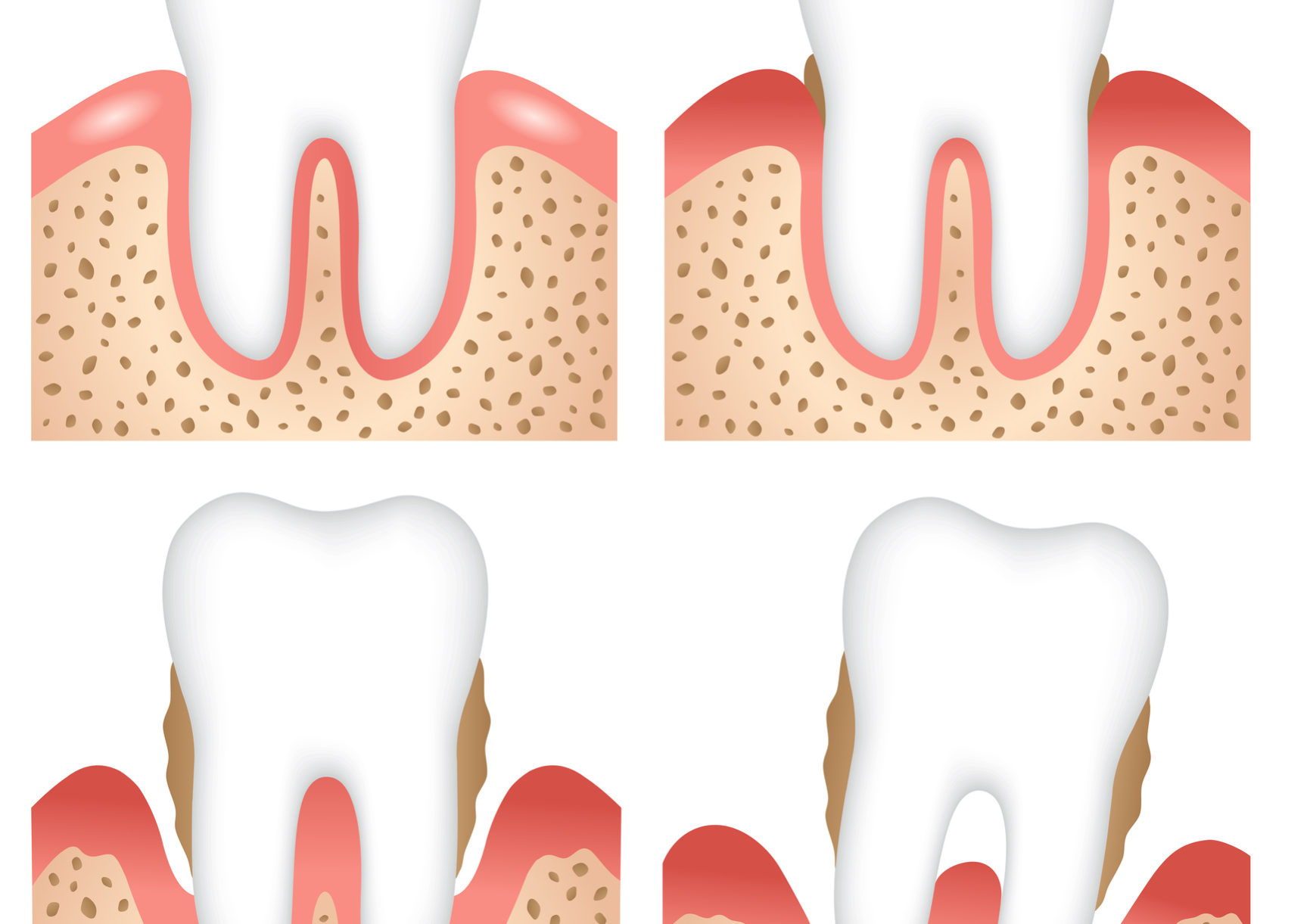 emergenza malattia paradontale