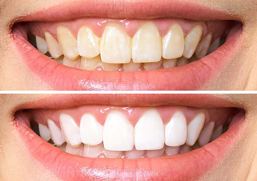 sbiancamento dentale